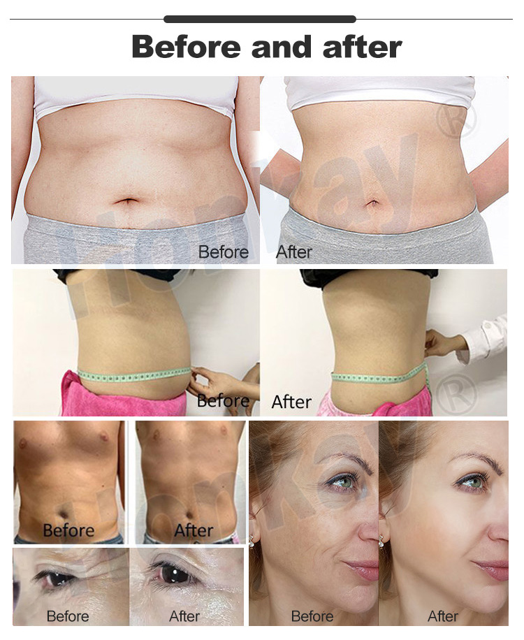 tecar therapy machine price