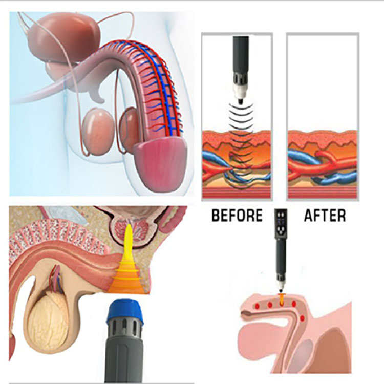 best price portable shockwave device osteoporosis