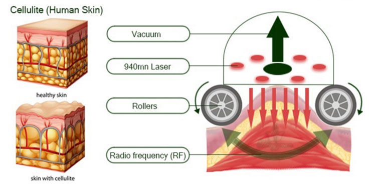 Body scultping vacuum roller massage machine