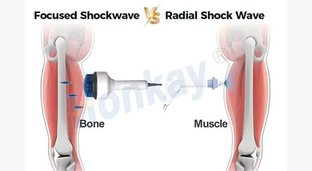 Diagram comparing focused shockwave and radial shock wave penetration, with the focused beam reaching bone and the radial wave acting on muscle