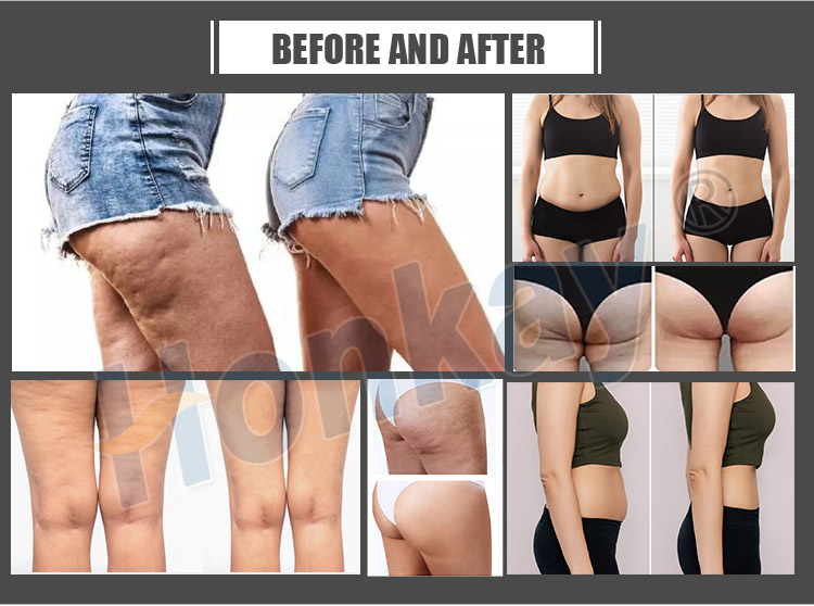 3 in 1 pressotherapy