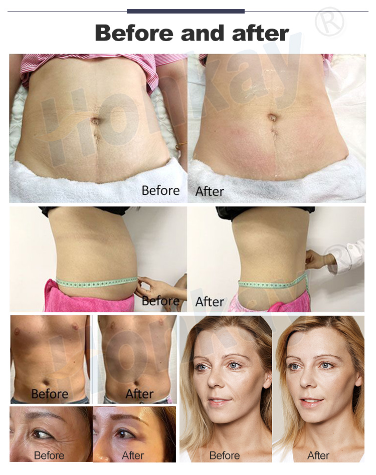 tecar therapy machine for sale